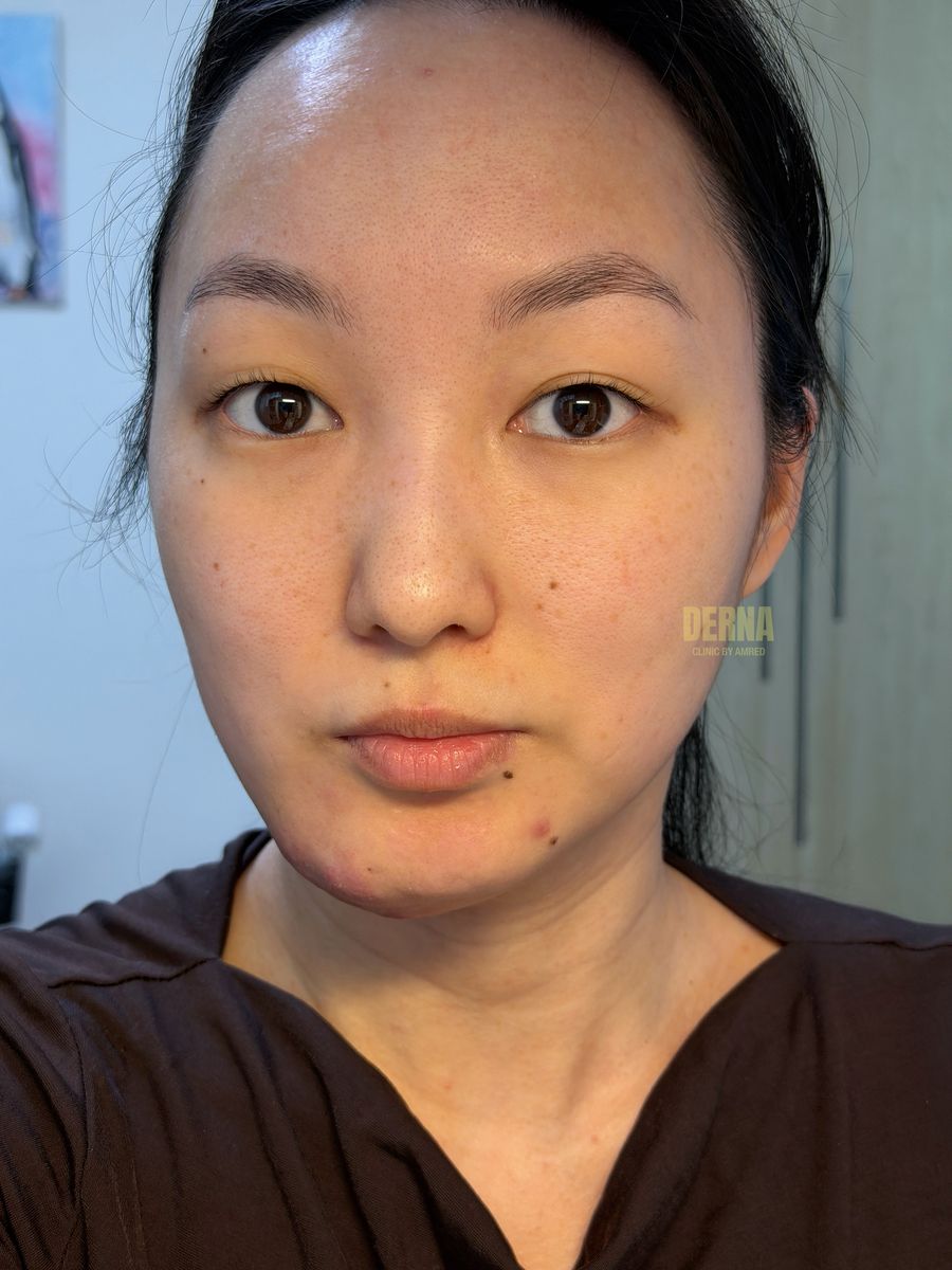 Pore & Scar Solution before