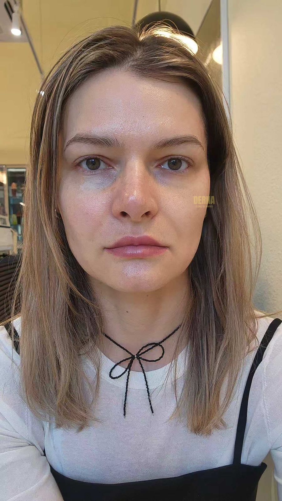 Rejuran before